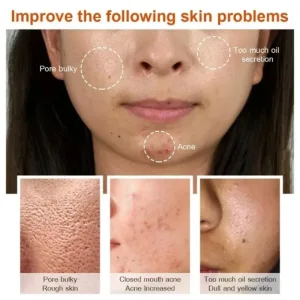 Imagen Del Producto &Quot;Revoluciona Tu Piel: Crema Antiacné Con Ácido Salicílico Para Poros Visiblemente Reducidos&Quot; | Compra Online En Tiendafiable