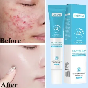 Imagen Del Producto &Quot;Revoluciona Tu Piel: La Crema Definitiva Para Combatir El Acné Y Decir Adiós A Las Espinillas&Quot; | Compra Online En Tiendafiable