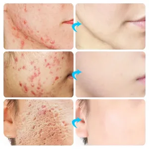 Imagen Del Producto &Quot;Revoluciona Tu Piel: La Crema Definitiva Para Combatir El Acné Y Decir Adiós A Las Espinillas&Quot; | Compra Online En Tiendafiable